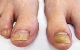 Nano Cold nail fungus, client 1 — before